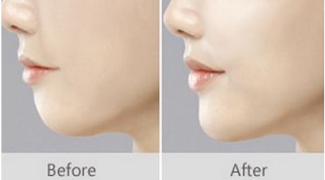 【最新醫(yī)療進(jìn)展】重塑小耳畸形，武漢一家醫(yī)院公開新療法