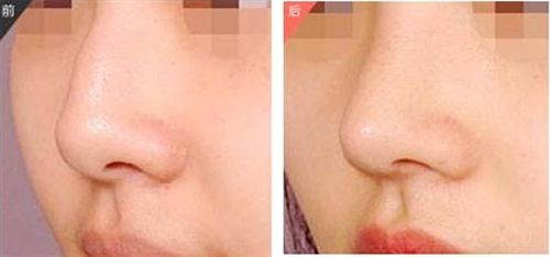 田孝臣醫(yī)生的鼻部整形效果如何？?jī)r(jià)格如何？技術(shù)評(píng)價(jià)+成功案例解析