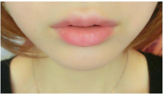 年齡段選擇，雙眼皮手術(shù)何時(shí)較適宜