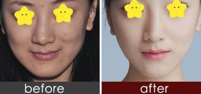 有效消腫的雙眼皮修復技巧由經驗豐富的整形醫(yī)生分享