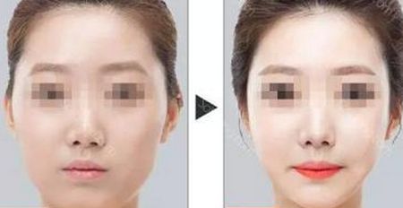 徐州整容機構(gòu)最佳隆鼻前六強盛名大揭曉！網(wǎng)友：此篇一看便心動，可投入購置。