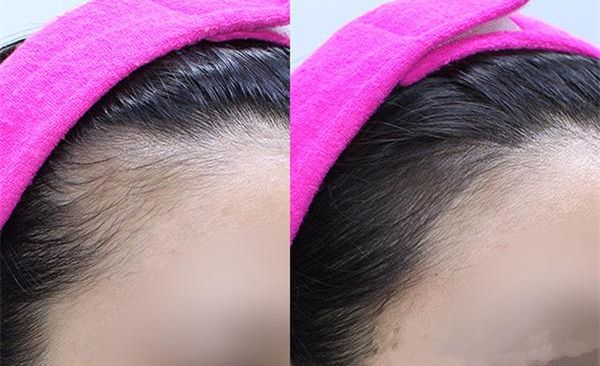 鄭州哪家醫(yī)院擅長(zhǎng)祛斑，技術(shù)精湛值得推薦！