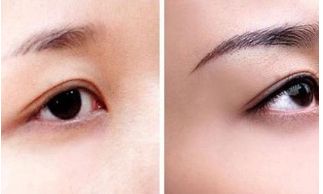 北京田永成醫(yī)美隆胸價格及術后效果解析