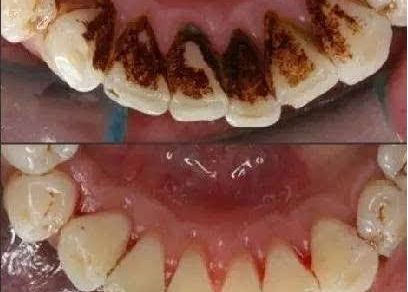 上海蝶可變整形醫(yī)院豐胸案例新鮮發(fā)布，引領時尚潮流