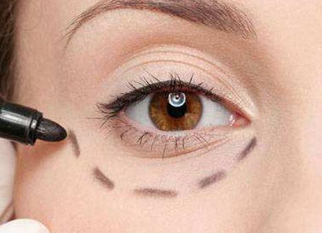 唐山優(yōu)秀雙眼皮修復(fù)醫(yī)生口碑盤點(diǎn)，案例分析、價(jià)格透明