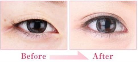 合肥哪家醫(yī)院的隆鼻效果好？技術(shù)過硬嗎？