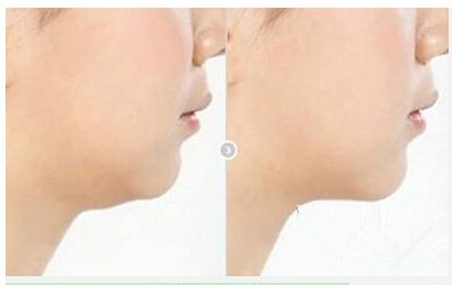 高偉的頜骨修復費用及綜合實力揭秘，醫(yī)生專業(yè)解讀技術(shù)及真實案例分享