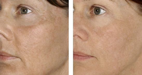 北京下頜角修復專家推薦，張笑天助您實現(xiàn)理想瘦臉！