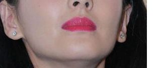 林沸騰曼陀假體現(xiàn)狀解析及2023價(jià)格一覽