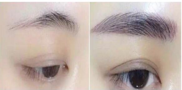 專家為您解答：涿州市哪家醫(yī)院可進(jìn)行瘦臉針治療？費用如何？醫(yī)師推薦為參考