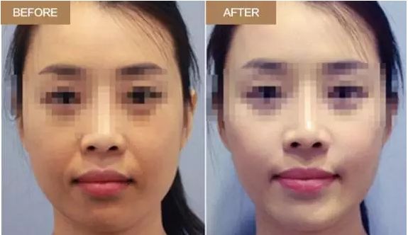 廣州哪家醫(yī)院鼻修復(fù)效果突出？這些醫(yī)院實(shí)力不可小覷！