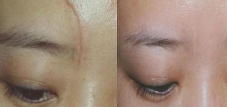 杭州一位醫(yī)生的雙眼皮手術(shù)實(shí)踐分享，持續(xù)80天的親身經(jīng)歷！