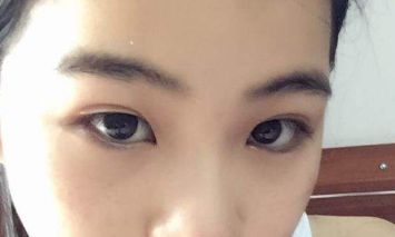 北京知音吸脂醫(yī)生分享大腿吸脂案例，想了解吸脂效果的朋友必看