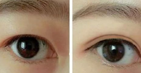 葉飛輪醫(yī)生：雙眼皮手術(shù)技術(shù)解析，真人案例揭秘！