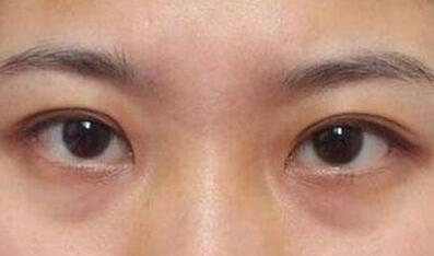 杭州東方整形吸脂到底值不值得嘗試？