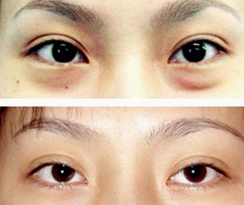 謝錦清：醫(yī)術(shù)高超，雙眼皮案例解析曝光！