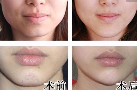 廣州人中縮短手術(shù)醫(yī)生推薦？網(wǎng)友真實評價與信息公開！