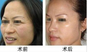 常見需要整形的手術(shù)嘴唇類型