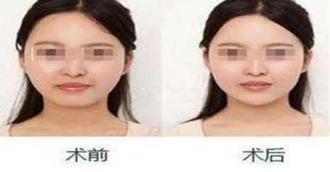 揚州隆胸專家2024榜單評選揭曉：挑選胸部整形領域翹楚！