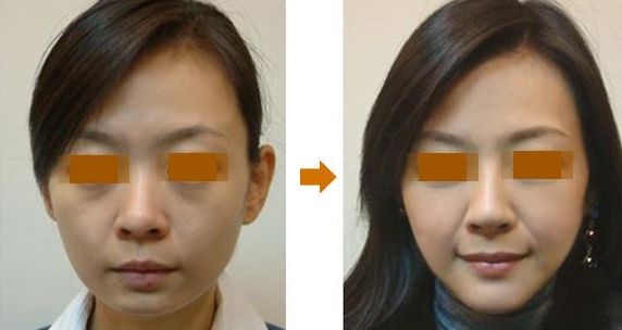 北京哪家鼻整形醫(yī)院評(píng)價(jià)好