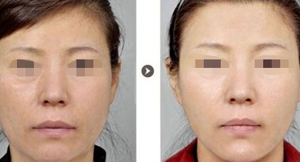 烏魯木齊哪里可以做雙眼皮手術(shù)？選擇哪家醫(yī)院效果好？