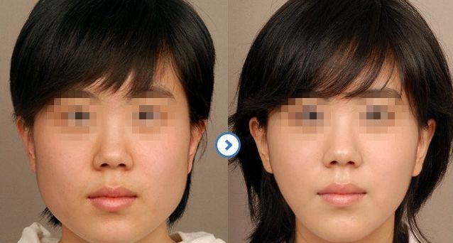 成都隆鼻醫(yī)生排行榜2024：專家推薦的醫(yī)院大揭秘！