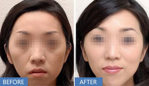 上海哪家醫(yī)院做打玻尿酸除皺效果好？