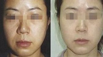 王自謙脂肪移植，存活率高受追捧