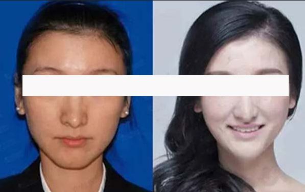 超肋材料隆鼻保存時間長久嗎？