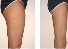 廣州荔灣人民醫(yī)院植發(fā)口碑評(píng)價(jià)及費(fèi)用參考