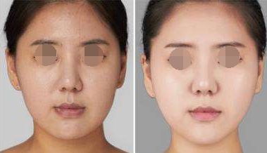 廣州曙光醫(yī)院：導(dǎo)航術(shù)后案例匯總