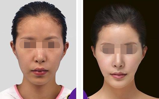 解密：重慶哪家醫(yī)院是最佳隆胸選擇