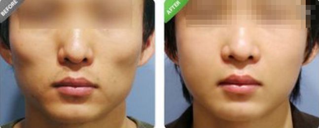 深圳哪家醫(yī)院的拉皮除皺效果最好？排名前幾位的醫(yī)院有哪些？