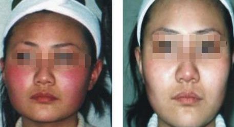 蘇州雙眼皮醫(yī)院排行榜，哪所醫(yī)院技術(shù)靠譜