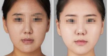 上海八院脂肪填充手術(shù)費(fèi)如何？專家拆解詳情及特色優(yōu)勢