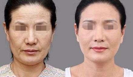 雍禾與碧蓮盛技術優(yōu)勢與收費比較