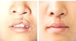 南昌割雙眼皮口碑醫(yī)院大盤點(diǎn)！這3家備受推崇