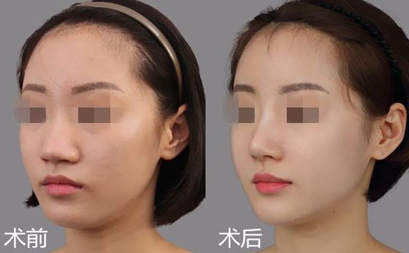 廣州拉皮哪家醫(yī)生技術(shù)比較好？TOP5名醫(yī)大揭秘