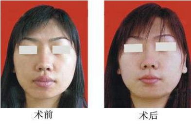 沈陽(yáng)做隆鼻手術(shù)哪家醫(yī)院效果好