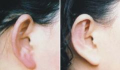 推薦：北京哪家隆鼻醫(yī)院口碑比較好？