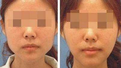 上海哪家醫(yī)院的下巴隆鼻手術效果最好？