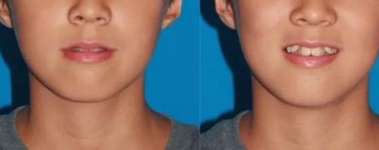 沈陽雙眼皮手術(shù)價(jià)格參考，名流、百嘉麗、杏林整形費(fèi)用更新【2024最新】