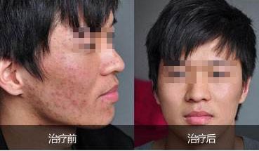 重慶吸脂哪家好？華美吸脂專家經(jīng)驗豐富，安全保障