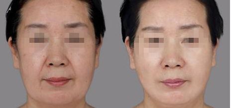 樂山哪家整形醫(yī)院雙眼皮比較好？匯總單六強(qiáng)預(yù)測(cè)