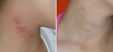 探索蘇州衛(wèi)康植發(fā)的口碑、手術效果及價格公開