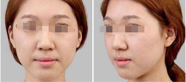 成都隆胸手術(shù)費(fèi)用及醫(yī)院選擇指南(2024最新)