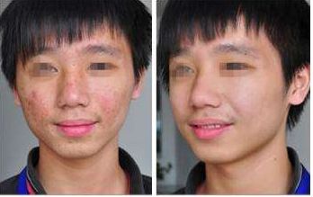 頂尖廣州隆胸修復整形醫(yī)院排行榜