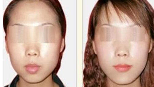 荊州哪個醫(yī)院能做隆鼻手術(shù)效果好？