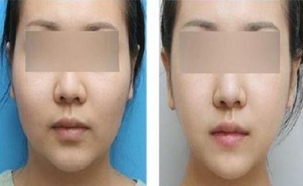 上海盧九寧醫(yī)生小腿塑形案例：顯微技術打造纖細美腿