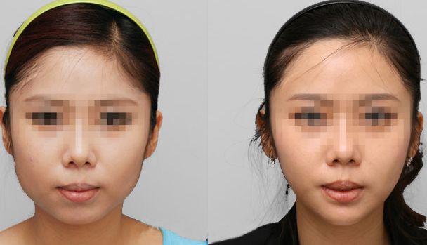 鷹鉤鼻矯正費用分析：價格大揭秘